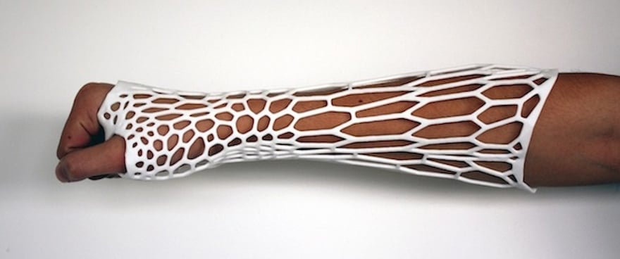 L’osteoid, un plâtre futuriste qui accélère la guérison